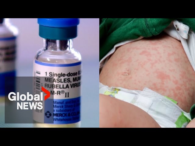 Canada: premature baby with measles dies amid outbreak in Ontario