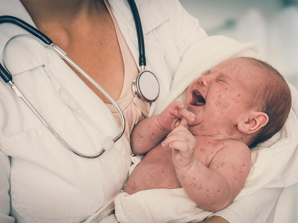 Six babies with unvaccinated mothers born with measles in Canada